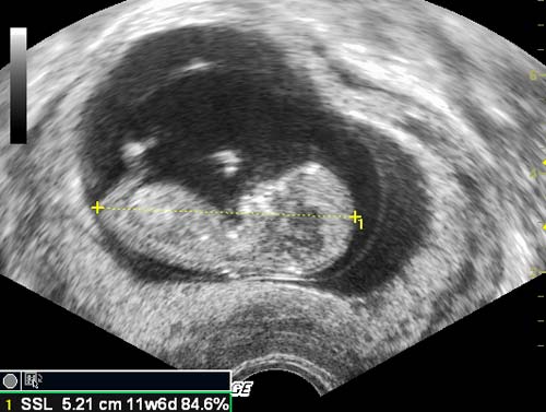 Гематома 6 недель. Краевая отслойка хориона. Кольцевидный хорион на УЗИ. Отслойка плодных оболочек. Отслойка плодных оболочек при беременности.
