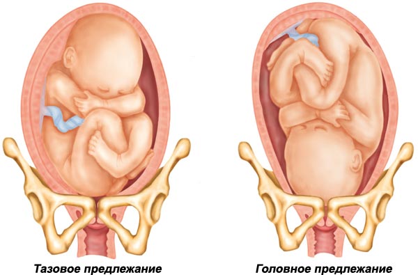 Положение ребёнка в животе при беременности